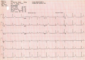 Figure 4. Typical Electrocardiogram Using the MAC PC